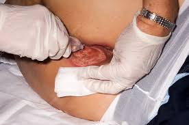 Cholecystectomy